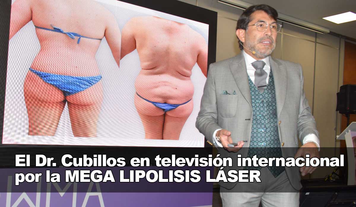 El Dr Cubillos en televisión internacional por la MEGA LIPOLISIS LÁSER